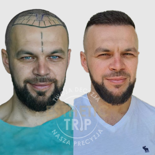 Esthetic Trip - Przeszczep włosów w turcji