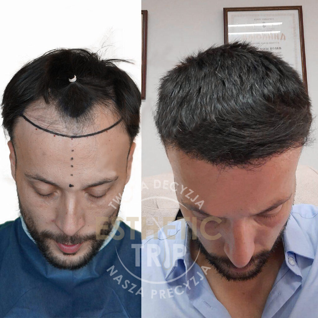 JAK UNIKNĄĆ NIEUDANEGO PRZESZCZEPU WŁOSÓW? - Esthetic Trip - Przeszczep włosów w turcji